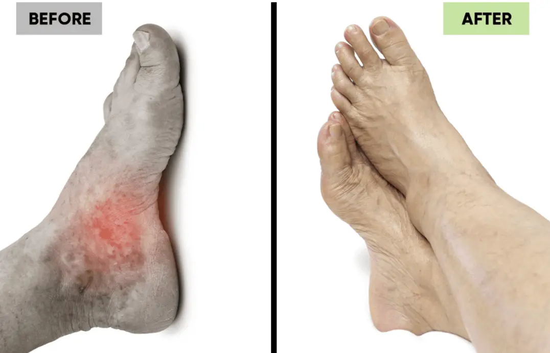 EMSense Neuropathy